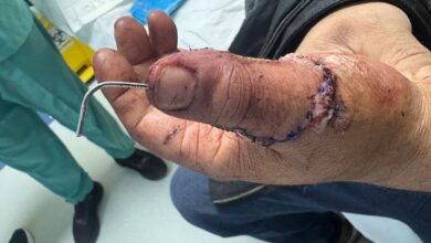 Photo of Greater Noida: हादसे में इलेक्ट्रिशियन ने गंवाया अंगूठा, फिर डॉक्टरों ने की सफल सर्जरी